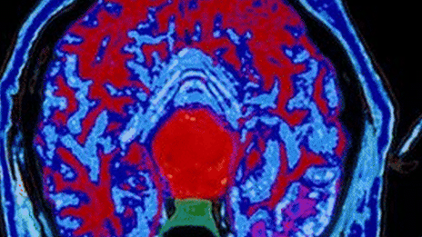 Coloured MRI scan of axial section through head