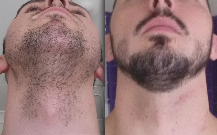 Minoxidil Before And After Beard Result - Minoxidil Guide for Thicker