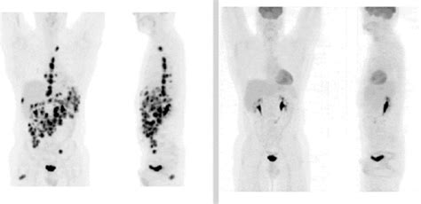 Pet Scan Images Of Lymphoma