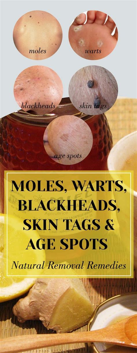 Moles, Warts, Blackheads, Skin Tags And Age Spots – Natural Removal ...