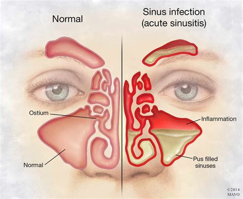 illustration of person's face with sinus infection and inflammation ...