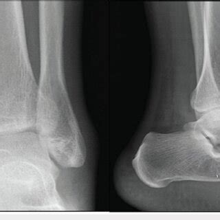 X-ray at presentation showing minimally displaced tibial plafond ...