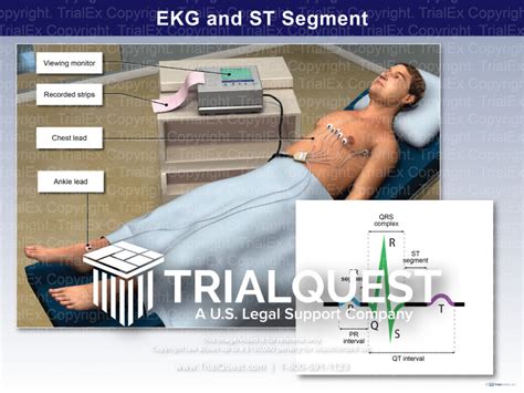 EKG and ST Segment - Trial Exhibits Inc.