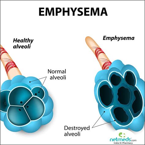 Emphysema: Causes, Symptoms And Treatment | Netmeds