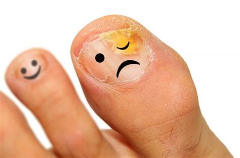 Is Your Thick, Discolored Nail Affected By a Nail Fungus?: AllCare Foot ...