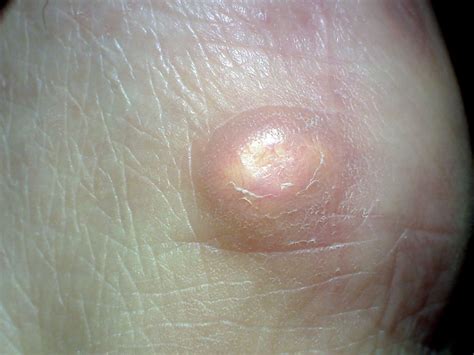 Boil Cyst: Symptoms, Causes, Treatment, 56% OFF