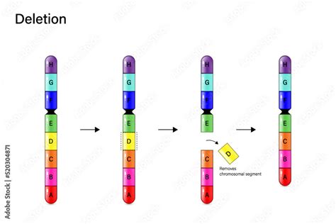 Chromosome Deletion. Genetic mutation. Alteration of chromosome ...