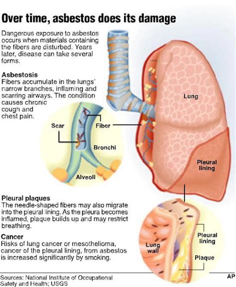 Mesothelioma info: Asbestosis, Cancer Asbestos, Mesothelioma Symptoms ...