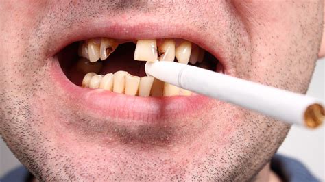 HOW DOES SMOKING AFFECT YOUR TEETH? - Tooth Loss - Bleeding Gums - NYC ...