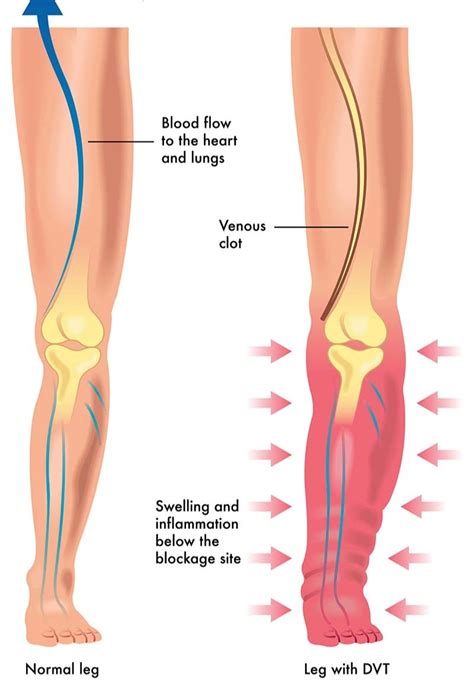 Acute DVT Treatment | Vascular Institute of The Rockies