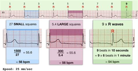 ECG Rate Interpretation • LITFL Medical Blog • ECG Library Basics