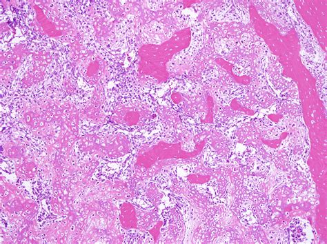 Osteosarcoma Histology