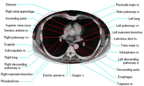 Ct Thorax Anatomy - Anatomical Charts & Posters