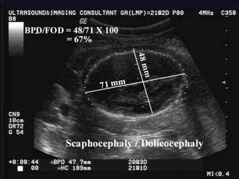 Navigating your child's diagnosis of Craniosynostosis