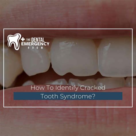 How To Identify Cracked Tooth Syndrome?