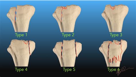 Tibial Plateau Fracture Classification Tibial Plateau Fracture | Porn ...