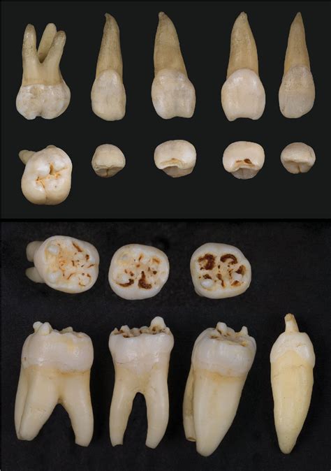 Mulberry molar | Semantic Scholar