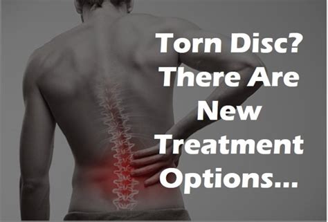 Torn Disc? There Are New Treatment Options... Centeno-Schultz Clinic