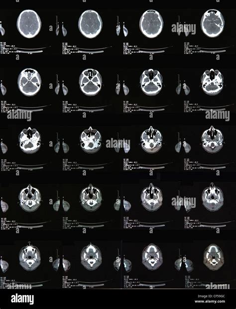 Ct scan report of head and skull hi-res stock photography and images ...