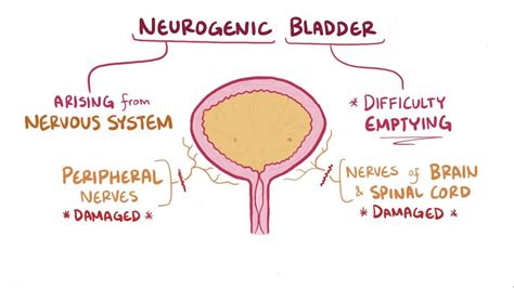 Autonomic Dysreflexia Mnemonic