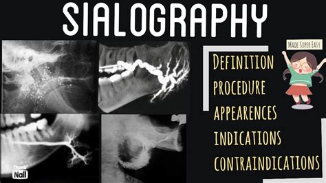 SIALOGRAPHY I SALIVARY GLAND IMAGING I ORAL RADIOLOGY LECTURE - YouTube