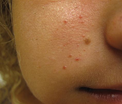 Unilateral Papules on the Face | MDedge Dermatology