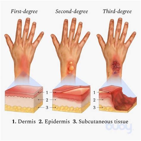 The 3 Types Of Burns – First Degree, Second Degree, Third Degree ...