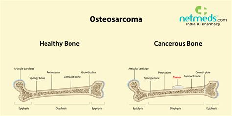 Osteoclastoma Symptoms