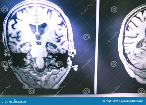 Alzheimer`s Disease on Film MRI Hippocampus Atophy Stock Photo - Image ...