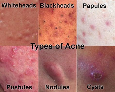 How Acne Forms, The Severe Pimples on Face and Other Part of Body - How ...