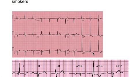 LVH, RVH (left ventricular & right ventricular hypertrophy) EKG ...