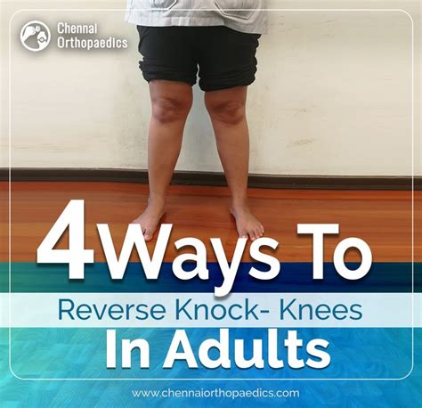 Knock knee is a medical condition in which a person’s knees point ...