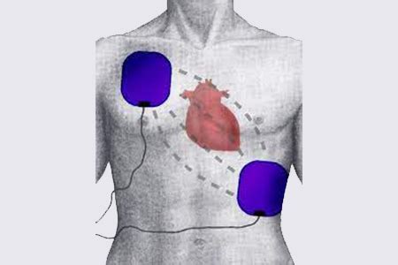 AED Pad Placement | Heartsmart