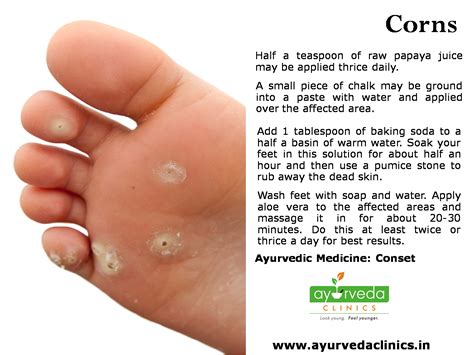 All to often, corns and calluses are the price we pay for neglecting ...