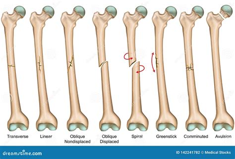 Types Of Bone Fractures Medical Educational Vector | CartoonDealer.com ...