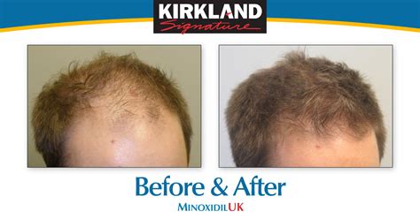 Minoxidil Before And After Pics