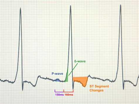 Asymptomatic WPW, Diagram. JETem 2017 - JETem