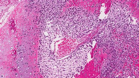 Osteosarcoma Histology