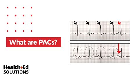 [10000ダウンロード済み√] sinus tachycardia with pac ecg 330915-How to tell the ...