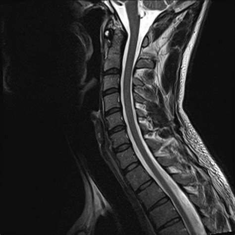 Image Gallery normal cervical spine mri