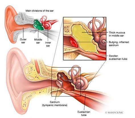 Eustachian Tube Dysfunction Remedies