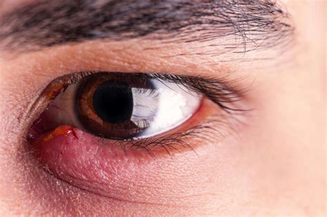 Stye On Eye: 10 Causes of Stye on an Eye