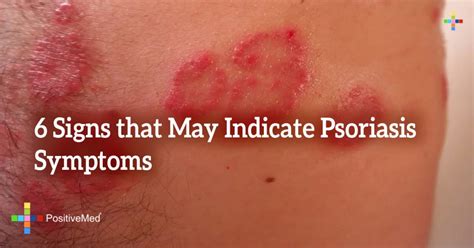 6 Signs that May Indicate Psoriasis Symptoms - PositiveMed