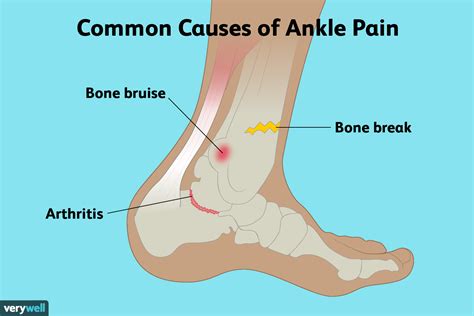 Ankle Pain Causes and Treatments