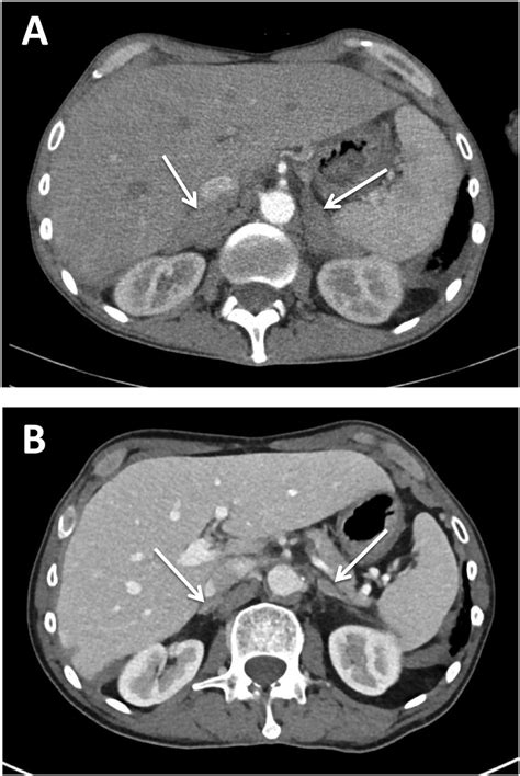 Adrenal Gland Ct Scan