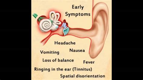 Inner Ear Infection Symptoms - YouTube