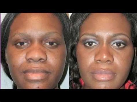 Bulbous nose surgery before and after | bulbousnose