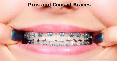 Pros and Cons of Braces - Dental Treatment - myayan.com