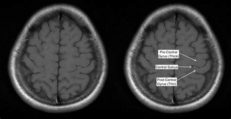 Postcentral Gyrus Mri