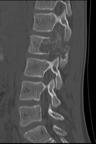 CT Scan of the Lumbar Spine - Cedars-Sinai